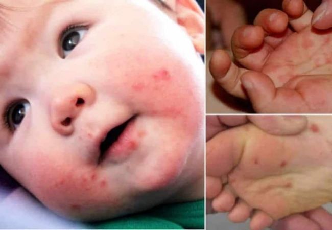 O que é a varicela?