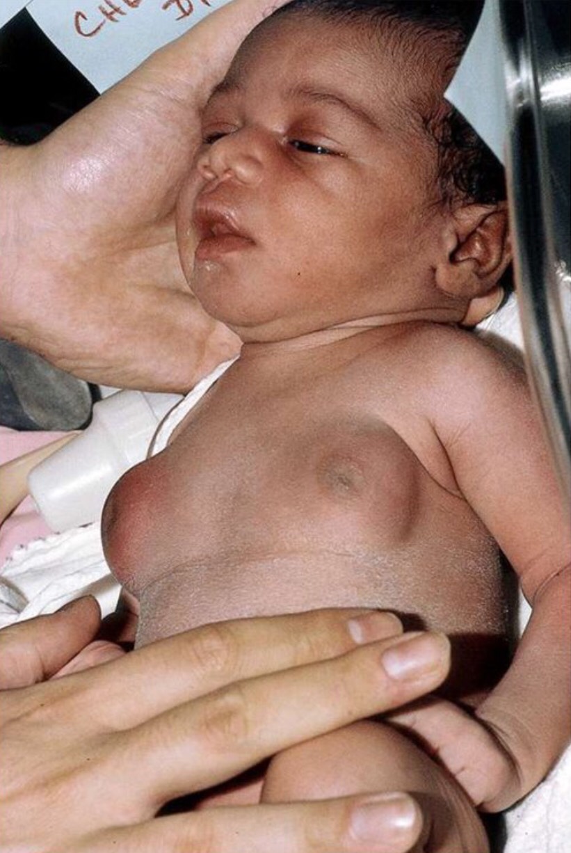 O meu filho nasceu com as maminhas aumentadas – é normal?