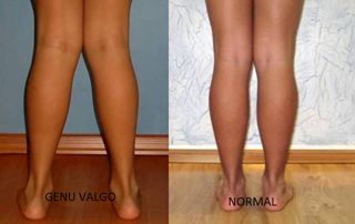 O meu filho mete os joelhos para dentro a andar – será normal?