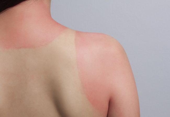 O que fazer perante um escaldão (queimadura solar)?