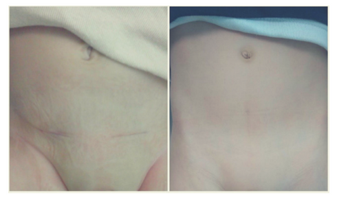 O meu bebé está irritado – será uma hérnia?