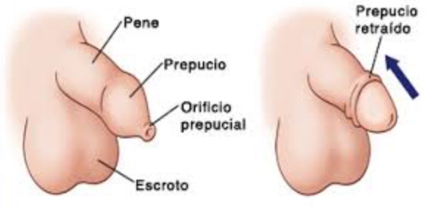 Fimose – 8 coisas que os pais devem saber sobre o prepúcio e a sua circuncisão
