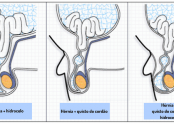 O meu bebé está irritado – será uma hérnia?