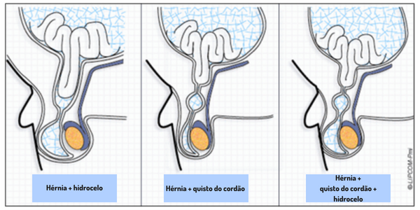 O meu bebé está irritado – será uma hérnia?