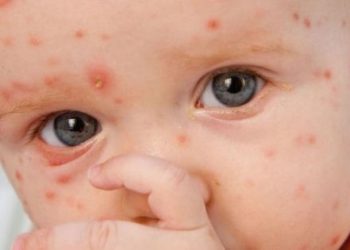 Varicela: as “pintinhas” mais típicas da infância