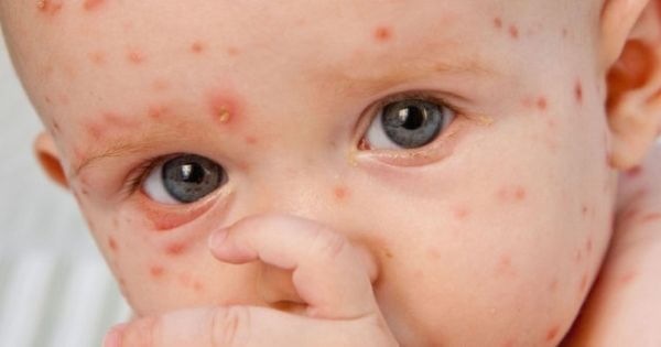 Varicela: as “pintinhas” mais típicas da infância