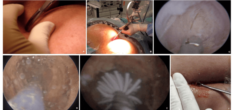 Cirurgia minimamente invasiva para o quisto sacrococcígeo