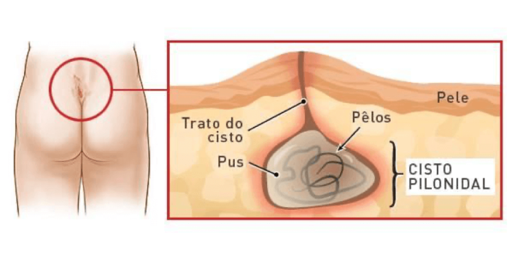 Cirurgia minimamente invasiva para o quisto sacrococcígeo