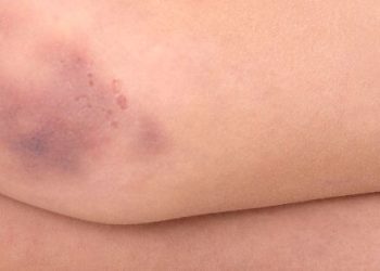 O meu filho magoou-se e tem um hematoma – o que devo faze?