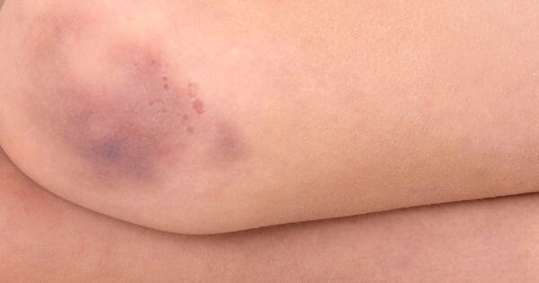 O meu filho magoou-se e tem um hematoma – o que devo faze?