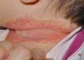 O meu filho tem o pescoço vermelho – o que posso fazer?