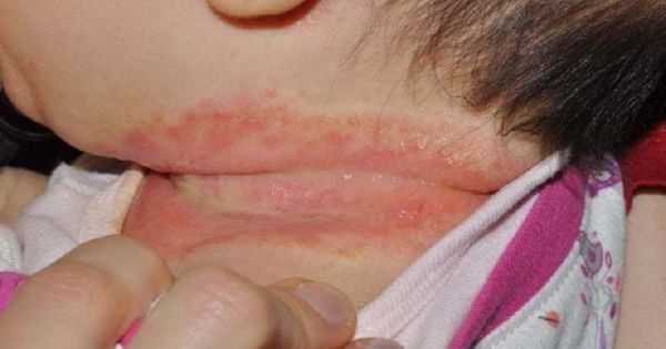 O meu filho tem o pescoço vermelho – o que posso fazer?