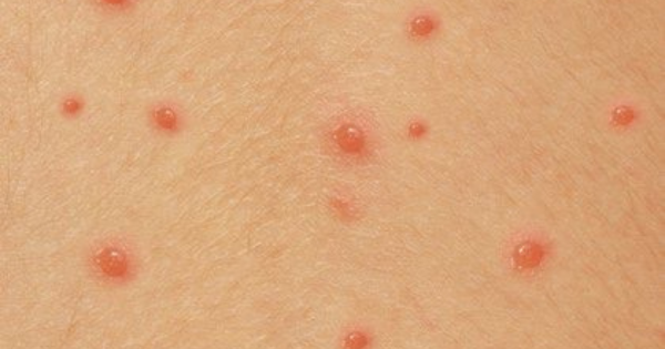 Varicela – o que é e como se manifesta?