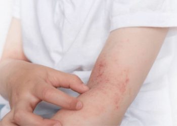 Como se diagnostica e trata a dermatite atópica?