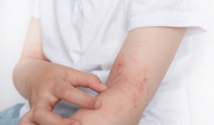 Como se diagnostica e trata a dermatite atópica?