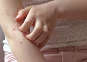 O que é a dermatite atópica?