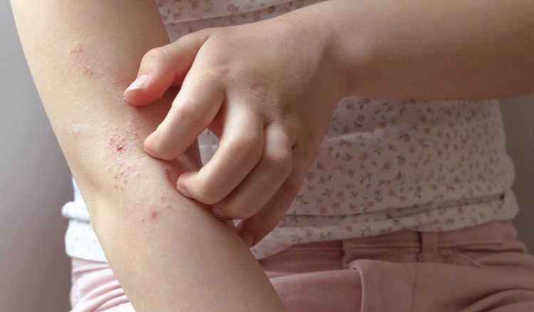 O que é a dermatite atópica?