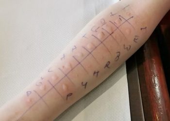 O que são os testes das alergias?