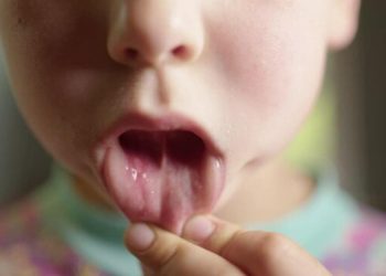 Quais são os cuidados alimentares quando uma criança tem aftas?