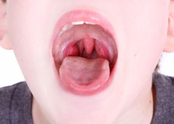 As 10 doenças mais comuns em Pediatria: Amigdalite