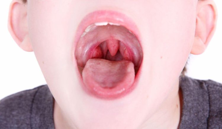 As 10 doenças mais comuns em Pediatria: Amigdalite