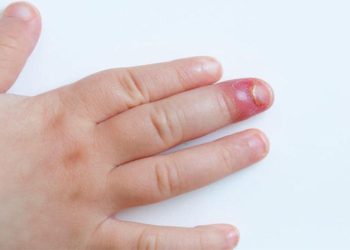 O que é um panarício?