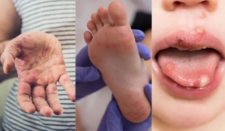 Doença de mão-pé-boca: o que fazer?