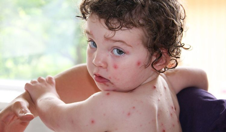 Varicela , qual é o risco de contágio?