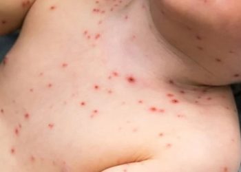 O medicamento que não se deve dar na varicela