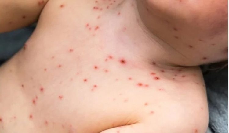 O medicamento que não se deve dar na varicela